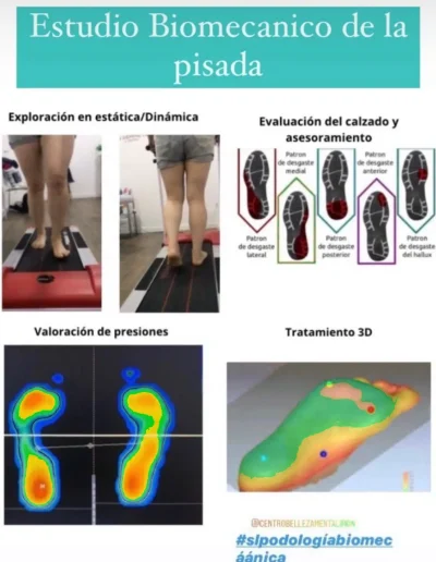 estudio biomecánica de la pisada en clinica sl